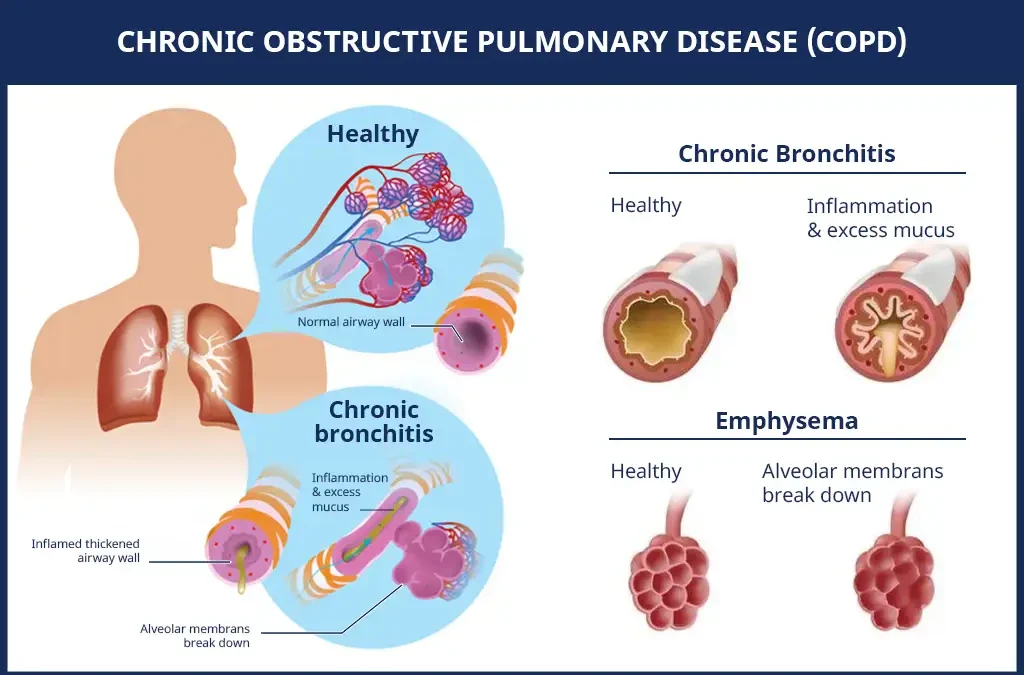 A Suffocating Shadow: Chronic Obstructive Pulmonary Disease in Sub-Saharan Africa